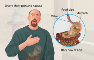 Hiatal heart burn