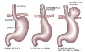 hiatal hernia 1