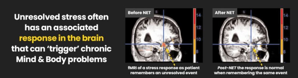 NET brain trauma research