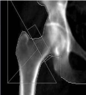 bone health test panel fracture x-ray of bone